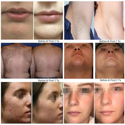 4000w High Power Diode Laser Hair Removal Cold Permanent Epilator Hair Removal Device Diode Laser Remove Hair Machine
