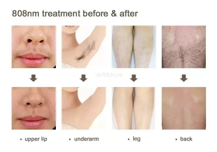 4000w High Power Diode Laser Hair Removal Cold Permanent Epilator Hair Removal Device Diode Laser Remove Hair Machine