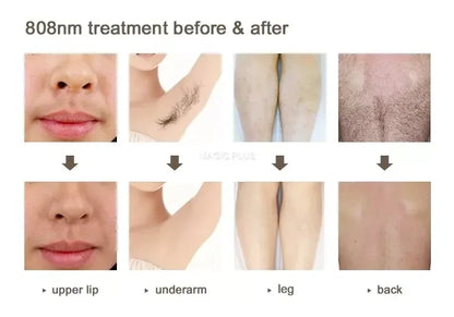 4000w High Power Diode Laser Hair Removal Cold Permanent Epilator Hair Removal Device Diode Laser Remove Hair Machine