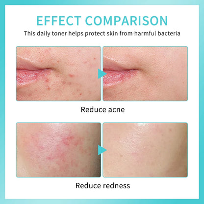 Hypochlorous Acid Spray Toner for Face Helps Reduce Redness Breakouts Soothing pH Balancing Toner Skincare