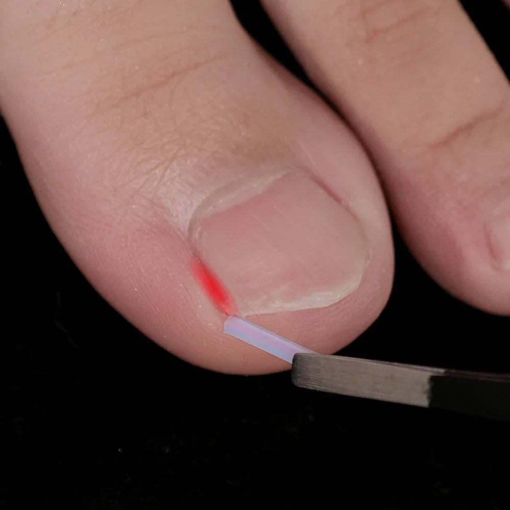 1-10 Box Elastic C-shaped Tube Padding Treatment Foot Care Invisible Groove Straightening Clip Ingrown Toenail Corrector Tools